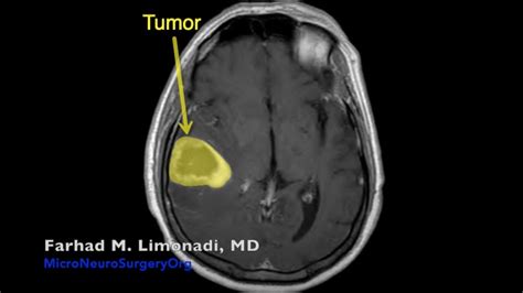 glioblastoma brain tumor surgery